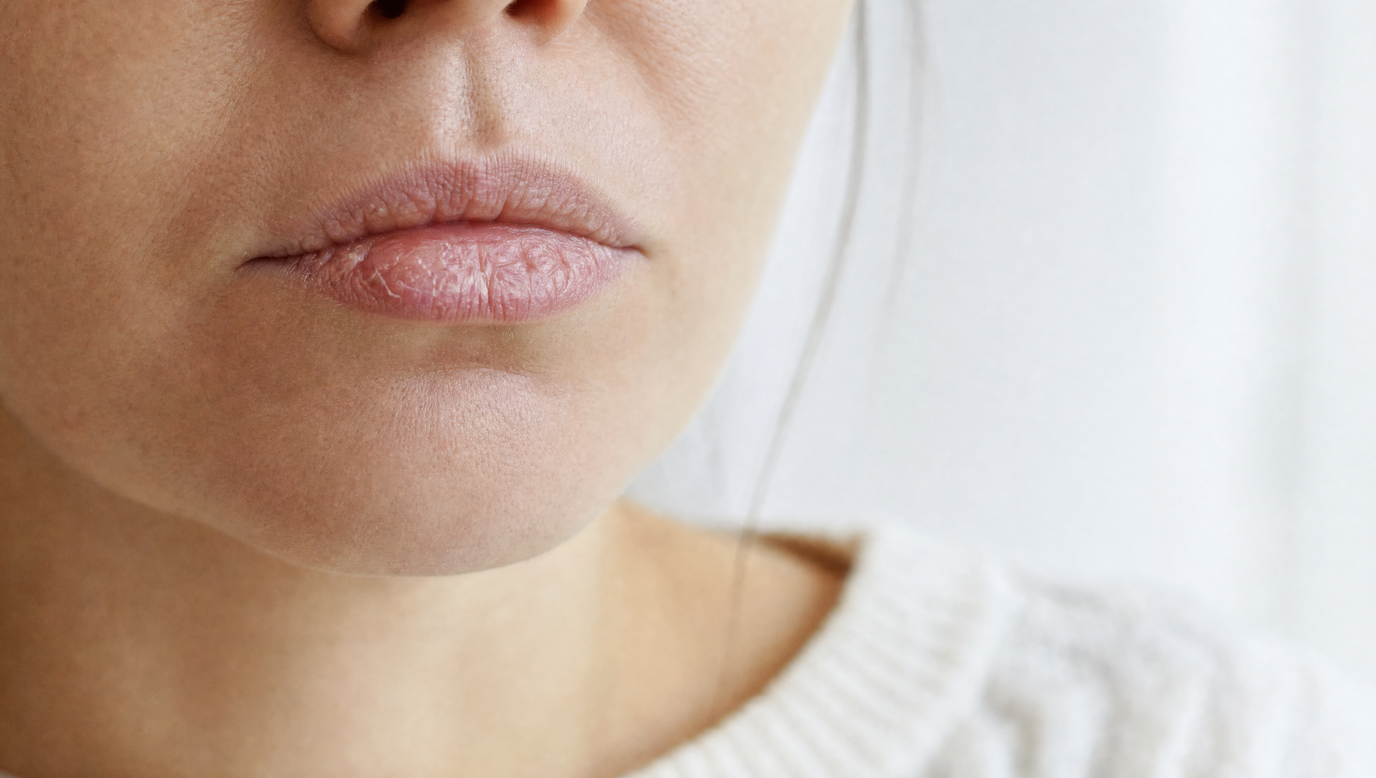 Close-up of a woman with dry, chapped lips showing the discomfort of a dry mouth