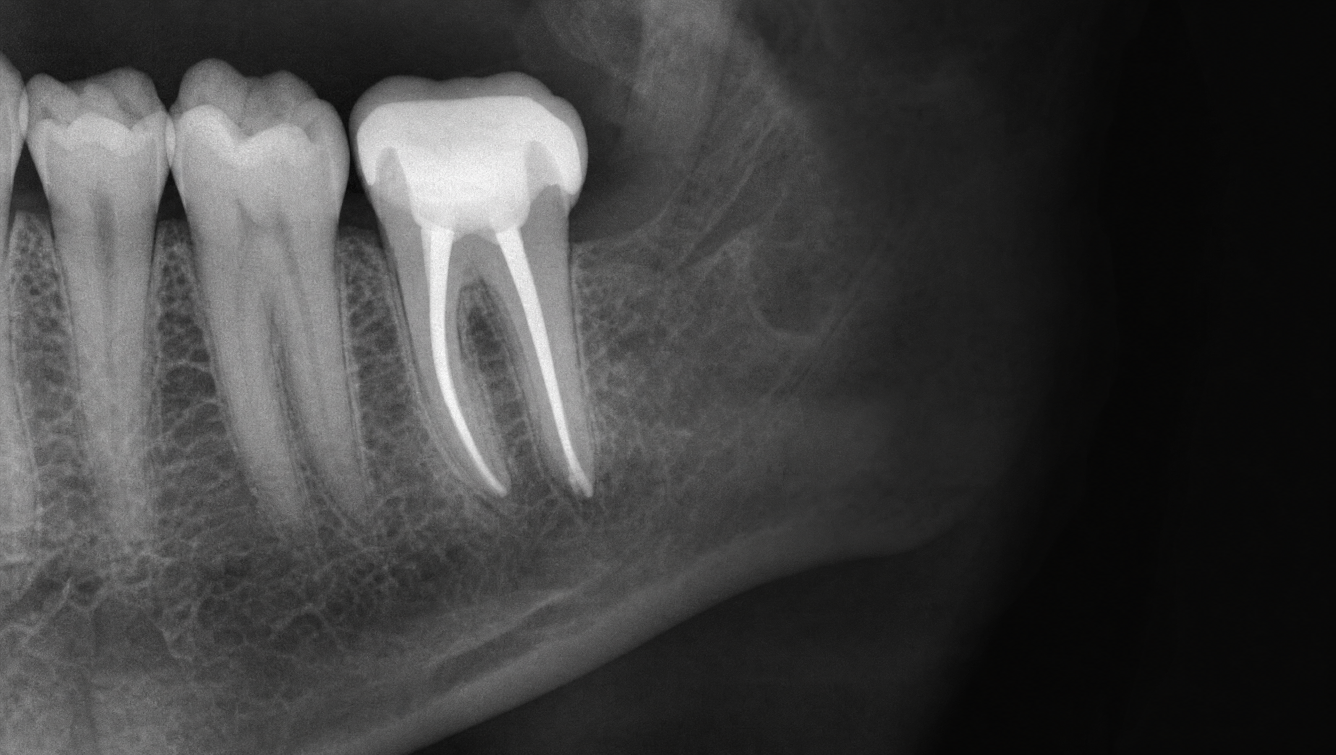 X-ray of a molar that has had a root canal, showing the filled canals