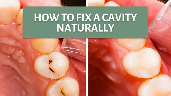 How To Fix Cavities Naturally