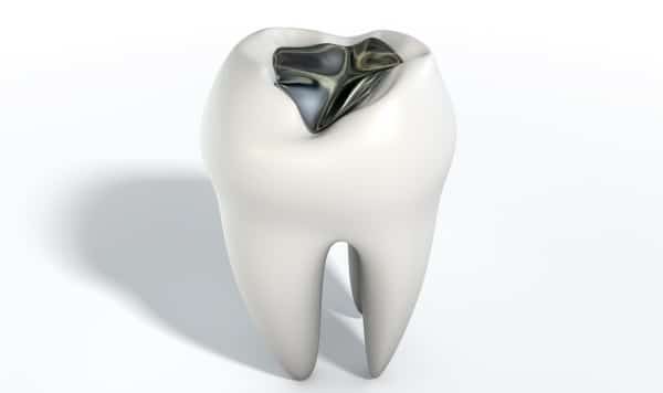 A molar with a dark silver amalgam (mercury) filling