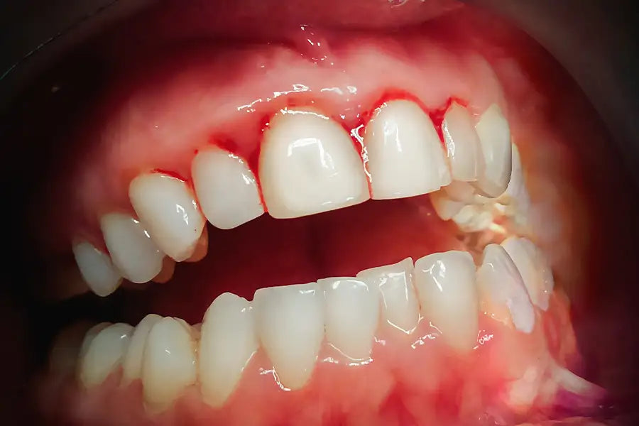 Close up of inflamed gums, an early sign of gum disease