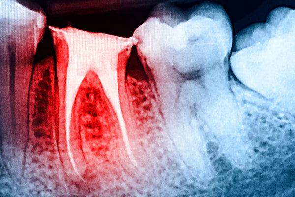 Root Canal Guide