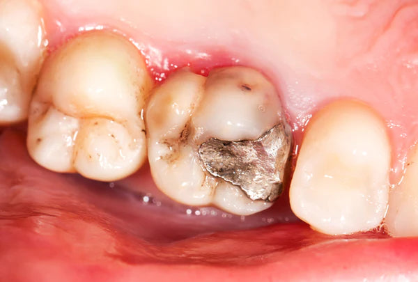 Prevent Cavities Guide