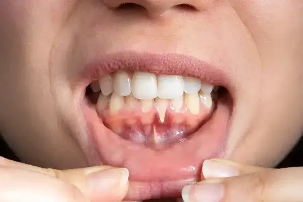 Gum recession exposing sensitive tooth roots