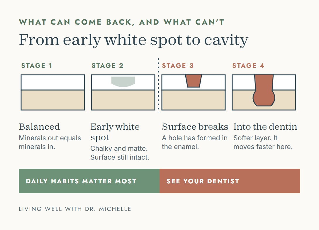 Four stages from balanced enamel to early white spot, surface break and cavity into the dentin, showing where daily habits matter and where to see a dentist